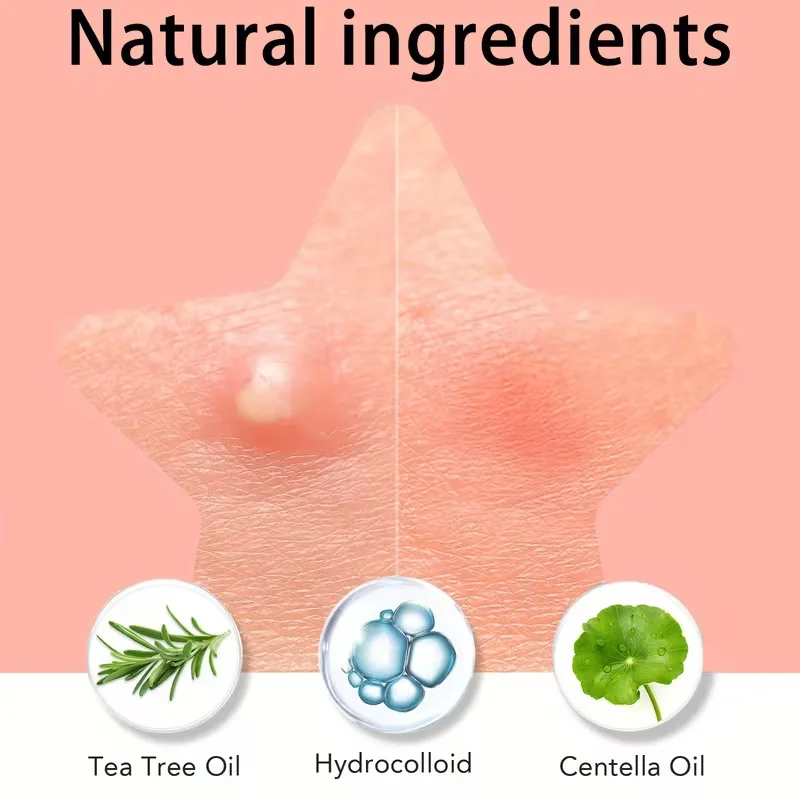 360pcs Colorful Acne Patches – gentle facial coverage for pimples and breakouts, suitable for all fair-to-beige skin tones, sens